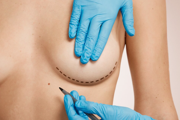 Breast Lift